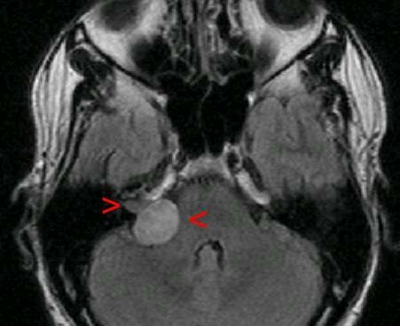 Neurinoma acustico Wikipedia
